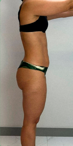 Depois — Lateral