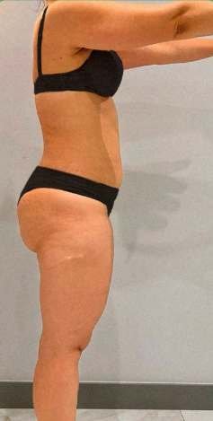 Antes — Lateral